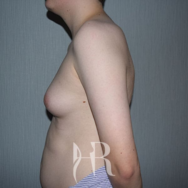 HR Plastic Surgery - Male Breast Reduction patient before 3